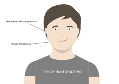 Great Speech Emphasizes Critical Importance of Speech Therapy to Recover from Rare Conditions Such as Ramsay Hunt Syndrome