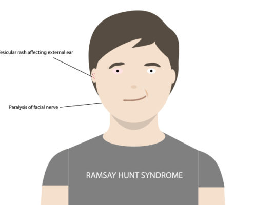 Ramsay Hunt Syndrome