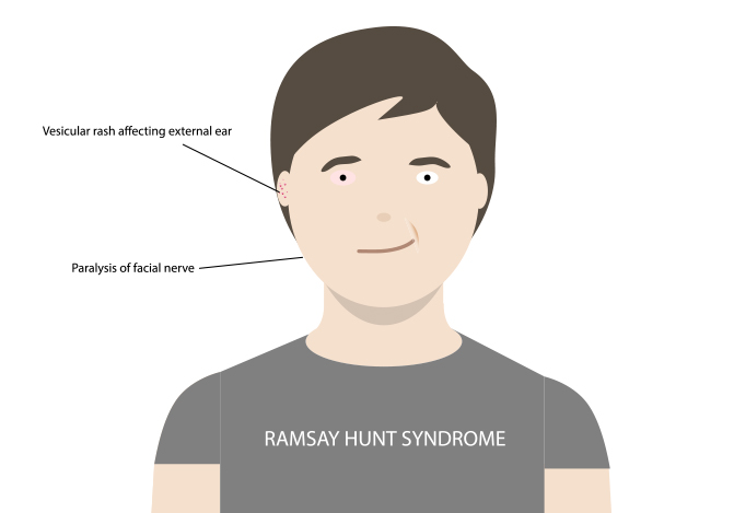 Ramsay Hunt Syndrome